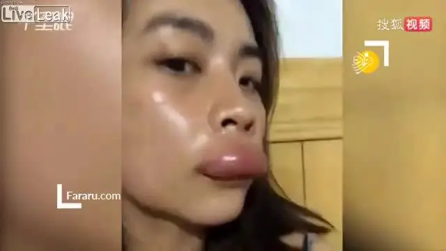 (ویدئو) پروتز لب با نیش زنبور!