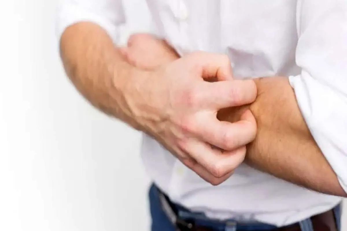 خارش پوست، جدیدترین نشانه ابتلا به ویروس کرونا