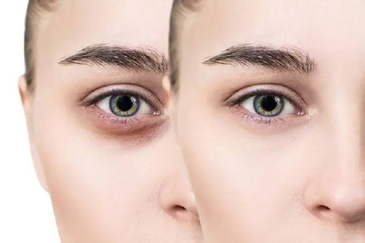 کربوکسی تراپی چیست و چگونه به جوانسازی پوست کمک می‌کند؟
