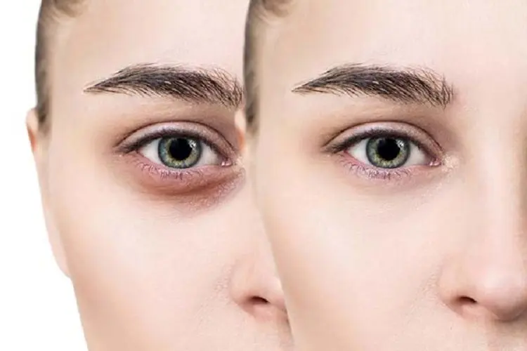 کربوکسی تراپی چیست و چگونه به جوانسازی پوست کمک می‌کند؟