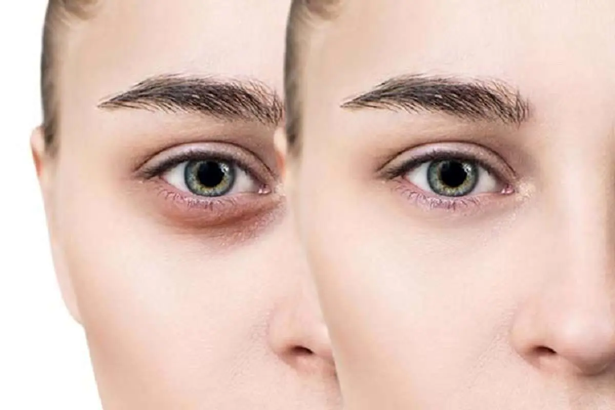 کربوکسی تراپی چیست و چگونه به جوانسازی پوست کمک می‌کند؟