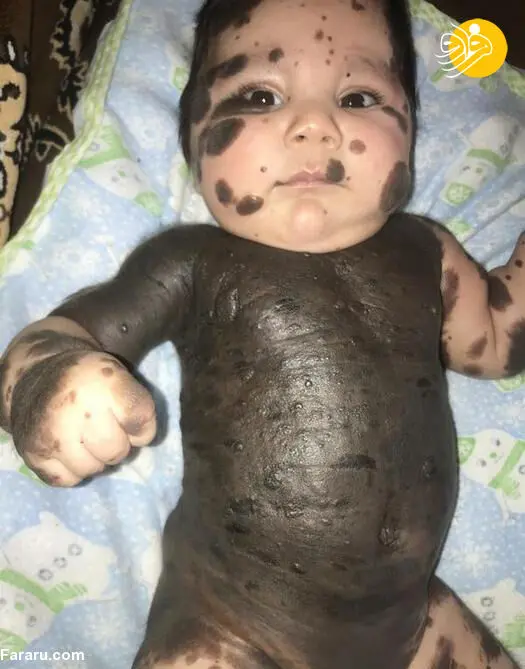 (تصاویر) نوزادی شبیه خرس پاندا!