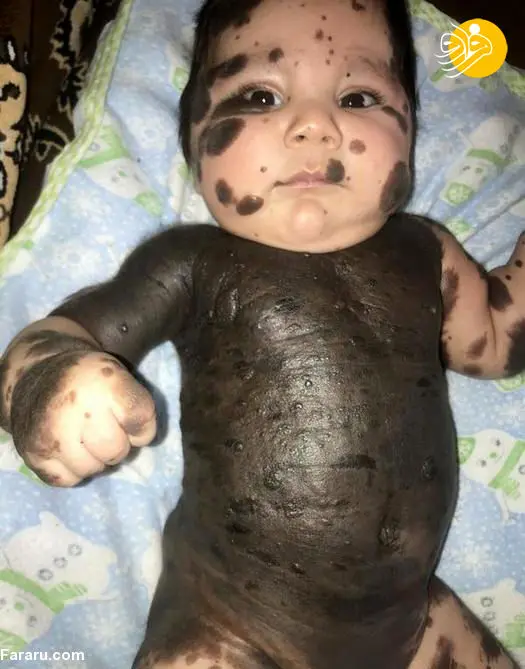 (تصاویر) نوزادی شبیه خرس پاندا!