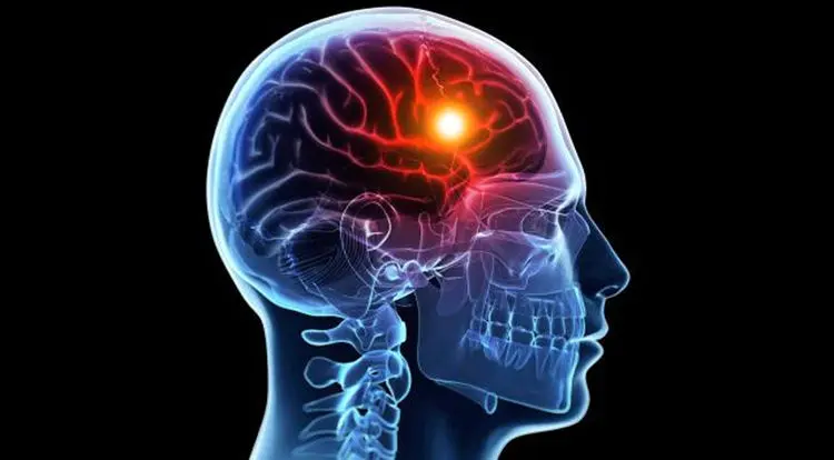علائم مهم سکته کدام است؟