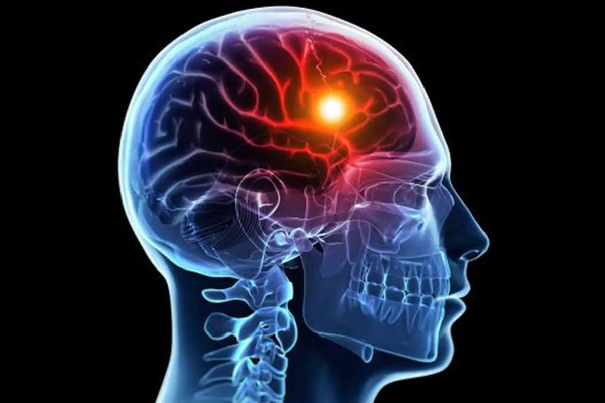 علائم مهم سکته کدام است؟