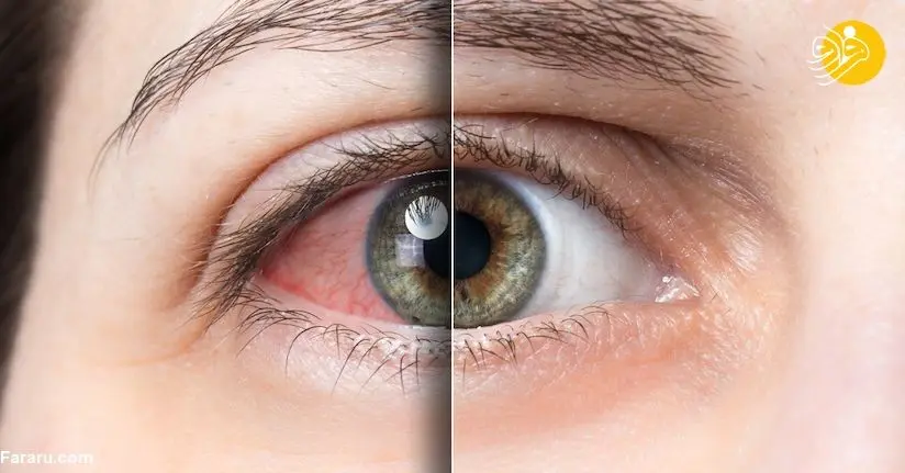 ۱۰ نکته تخصصی برای رفع خستگی چشم ناشی از کار زیاد با رایانه
