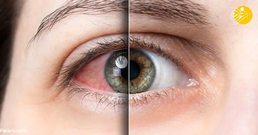 ۱۰ نکته تخصصی برای رفع خستگی چشم ناشی از کار زیاد با رایانه