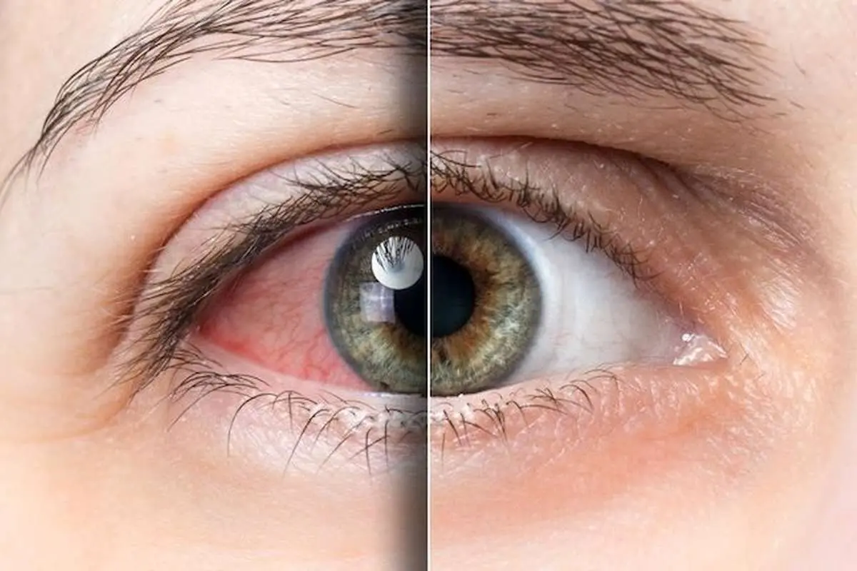 ۱۰ نکته تخصصی برای رفع خستگی چشم ناشی از کار زیاد با رایانه