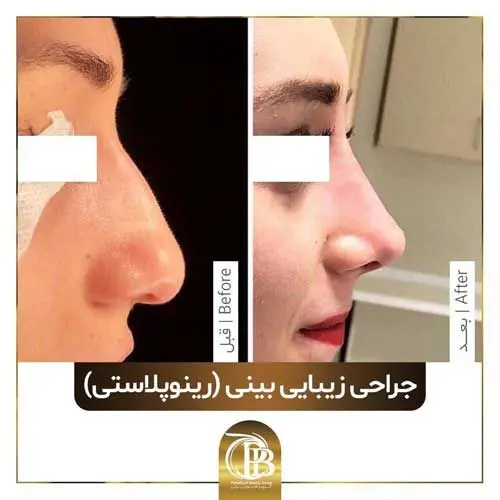 عمل بینی یا جراحی بینی چند نوع است و آیا همه می توانند انجام دهند؟