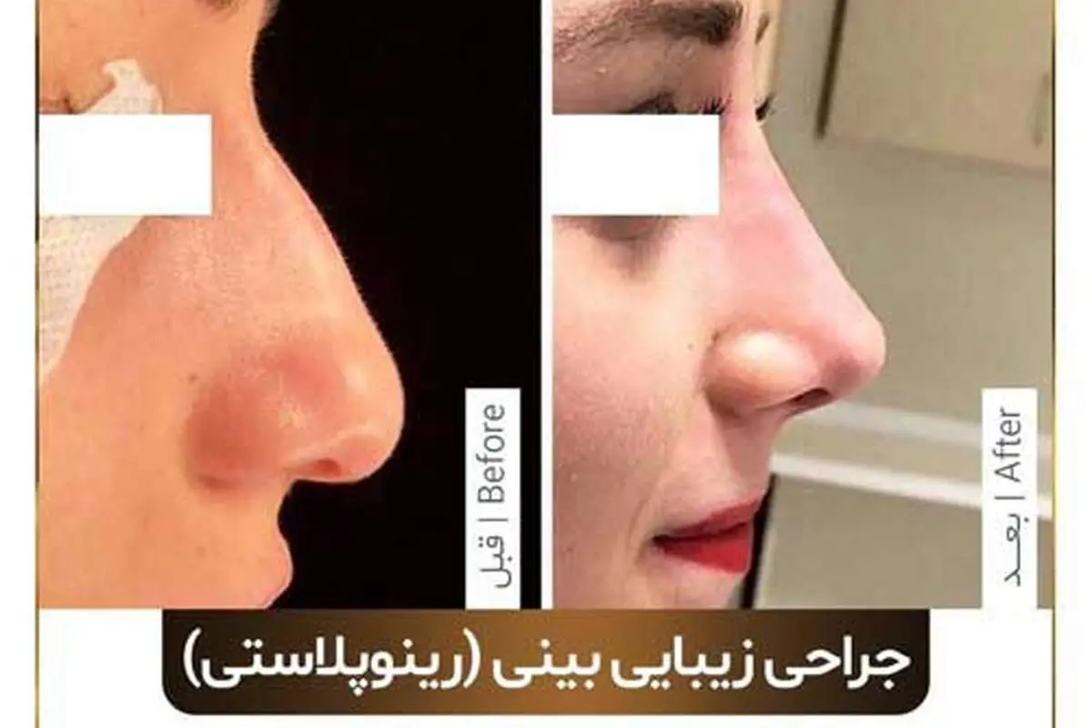 عمل بینی یا جراحی بینی چند نوع است و آیا همه می توانند انجام دهند؟