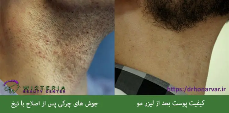 مزایا و فواید لیزر موهای زائد نسبت به سایر روش ها