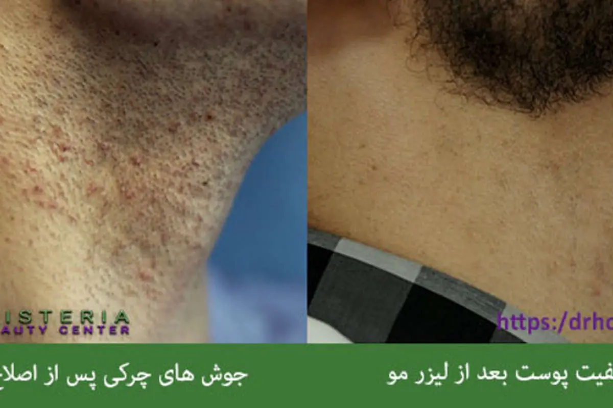 مزایا و فواید لیزر موهای زائد نسبت به سایر روش ها