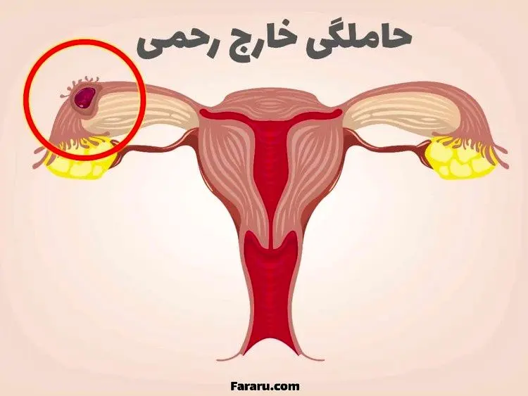 حاملگی خارج رحمی؛ چرا رخ می‌دهد و چه علائمی دارد؟