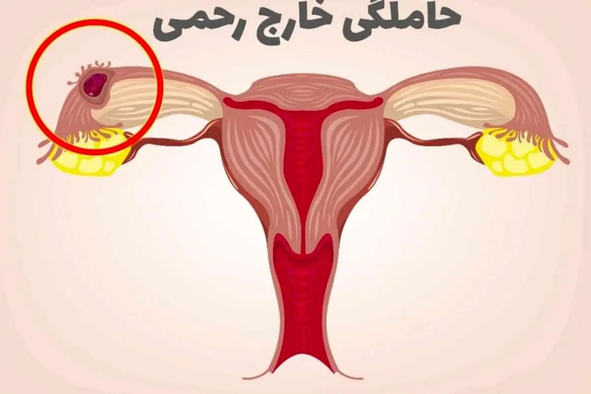 حاملگی خارج رحمی؛ چرا رخ میدهد و چه علائمی دارد؟