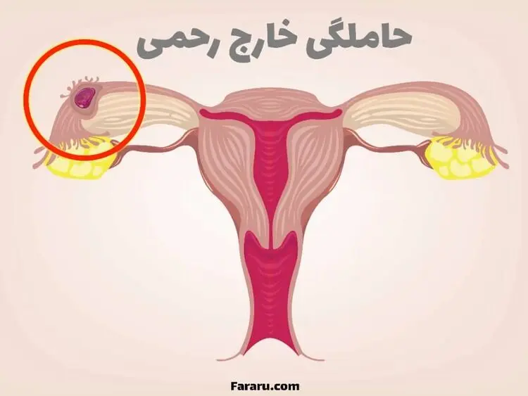 حاملگی خارج رحمی؛ چرا رخ می‌دهد و چه علائمی دارد؟