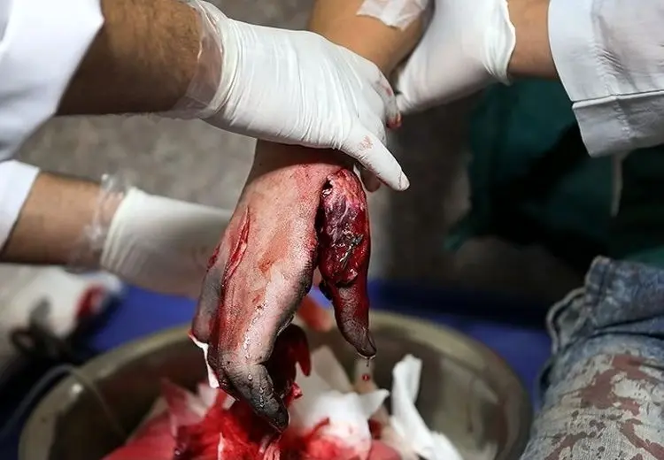 سوختگی شدید ۴ نوجوان بر اثر انفجار مواد محترقه