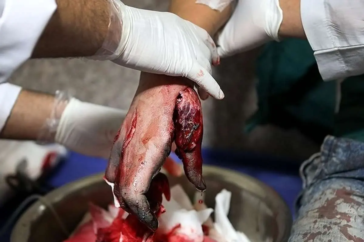 سوختگی شدید ۴ نوجوان بر اثر انفجار مواد محترقه
