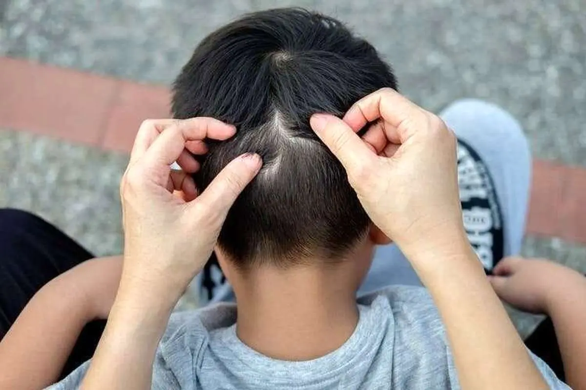 روش های موثر درمان شپش سر