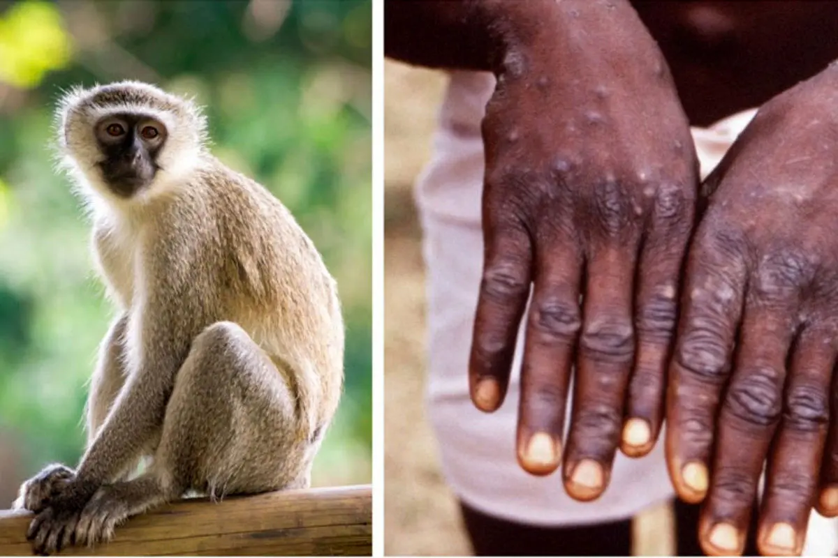 ریشه و علائم «آبله میمونی» چیست؟