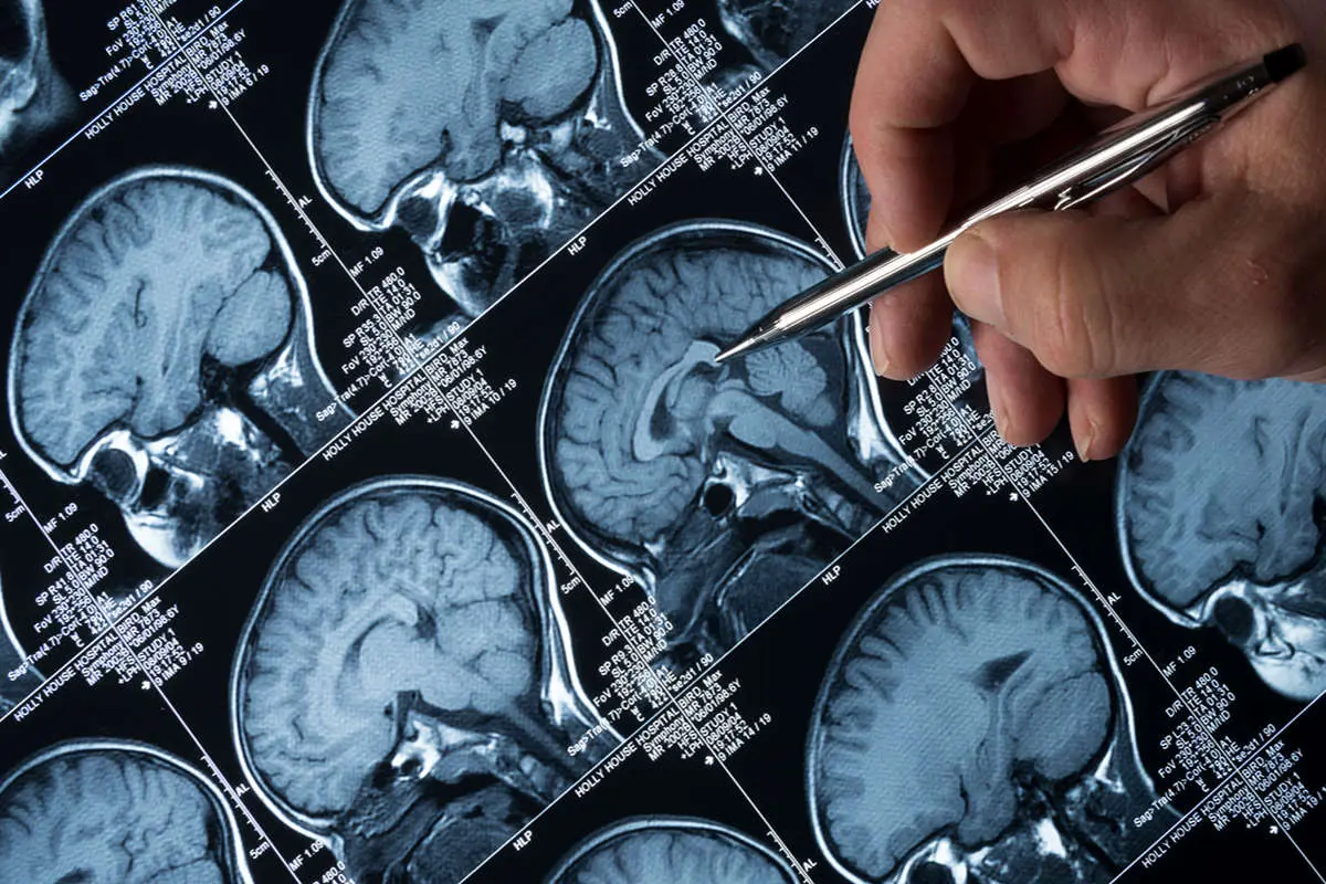 خطر جدی افزایش ابتلا به آلزایمر در جهان تا سه دهه آینده