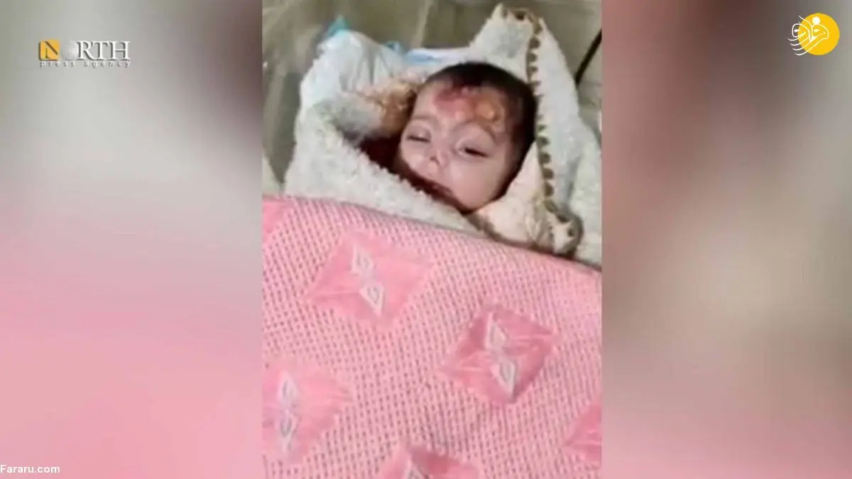 (تصاویر) موش‌ها بینی نوزاد دختر را جویدند!