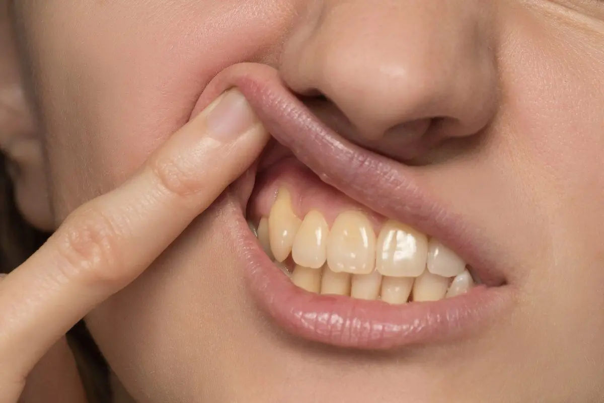 از لکه‌های سیاه روی لثه چه می‌دانید؟