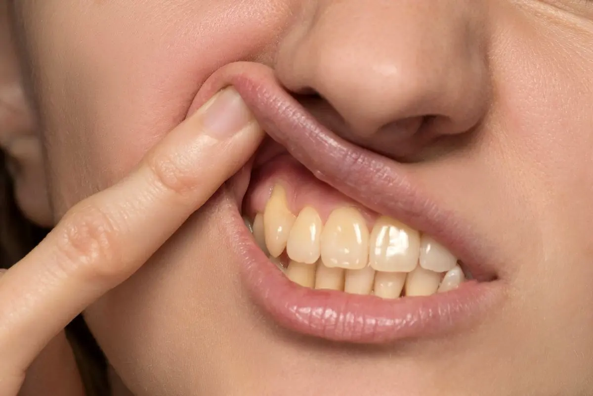 از لکه‌های سیاه روی لثه چه می‌دانید؟