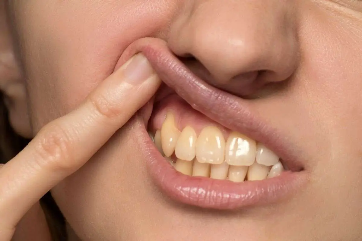 از لکههای سیاه روی لثه چه میدانید؟