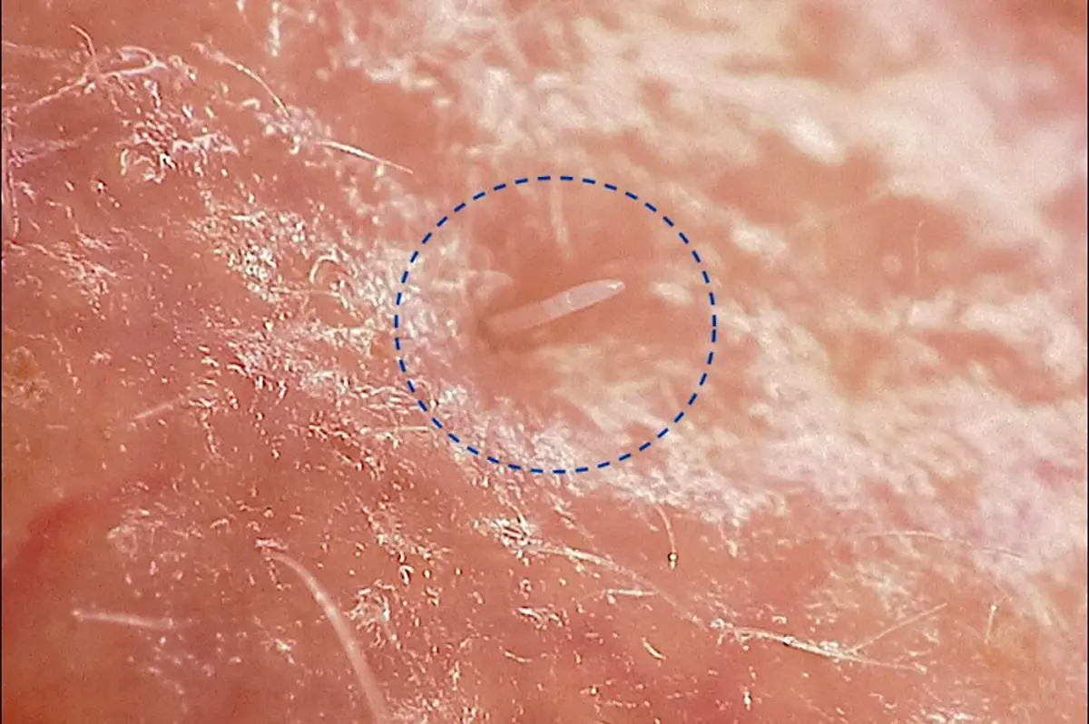 زندگی مخفیانه یک کنه مرموز در صورت ما!