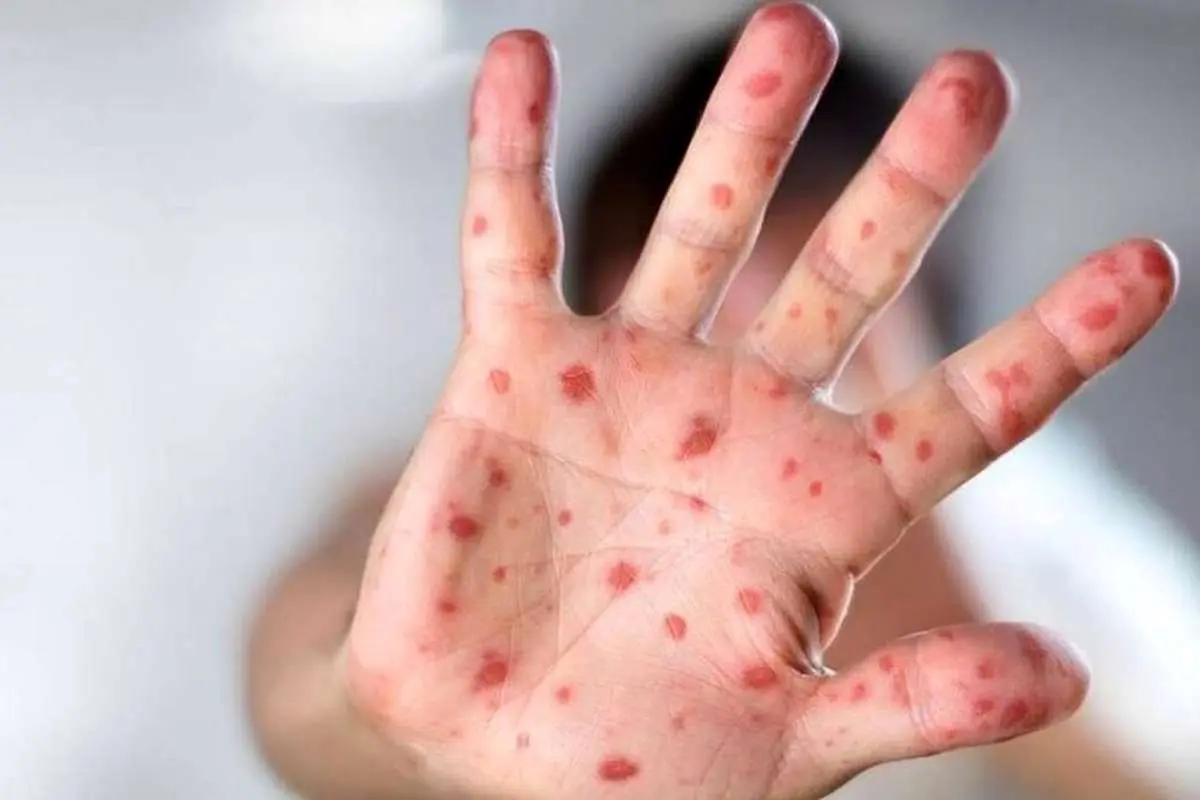 از آبله میمون چه خبر؟