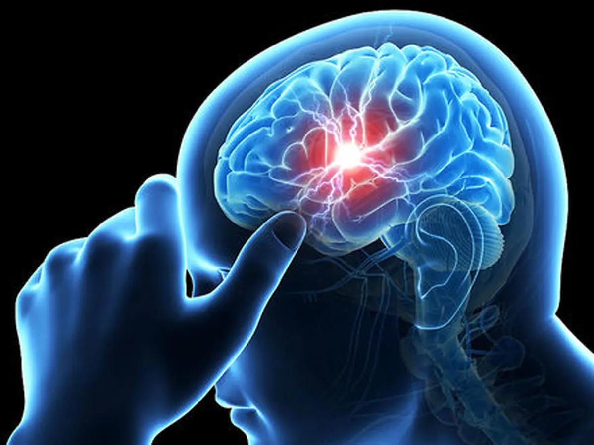 افزایش آمار سکته مغزی به دلیل شیوع کرونا
