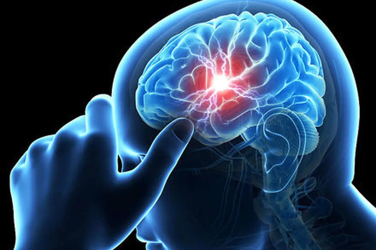 افزایش آمار سکته مغزی به دلیل شیوع کرونا