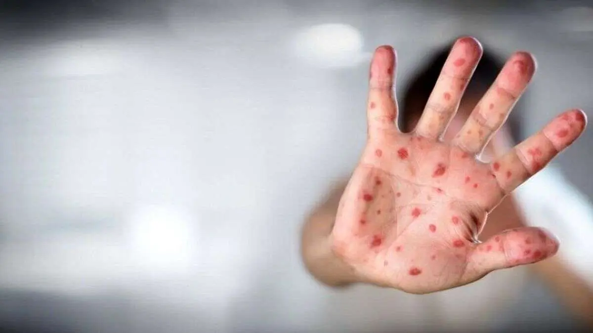 شیوع آبله میمونی چقدر نگرانکننده است؟