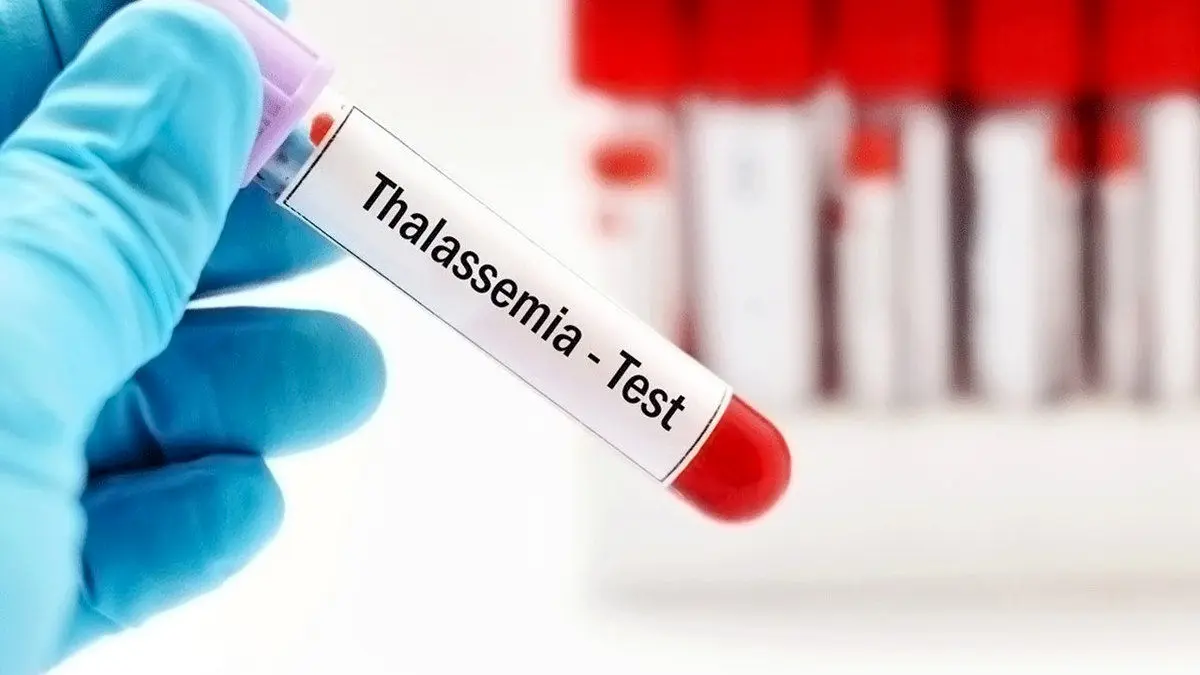 «با اجرایی شدن قانون جوانی جمعیت، تولد بیماران تالاسمی افزایش داشته است»