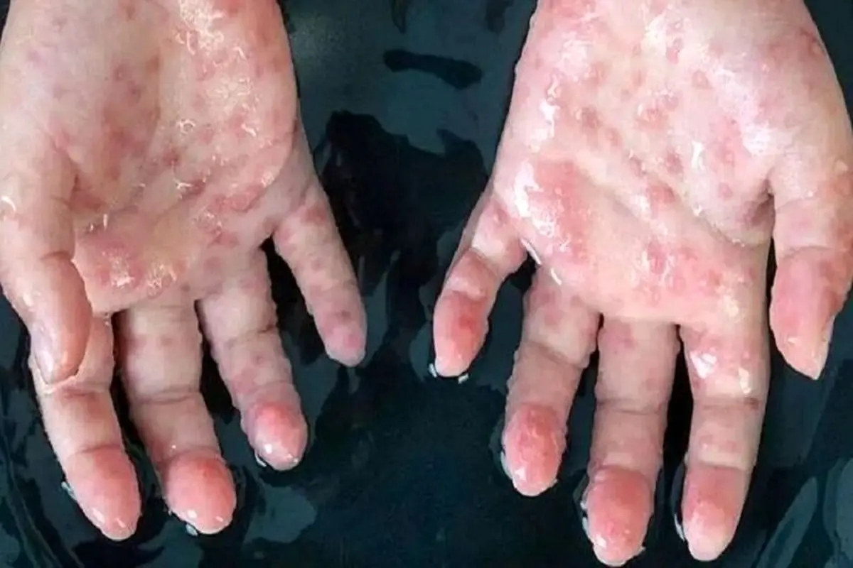 جزئیات جدید از زن ایرانی مبتلا به آبله میمونی در اهواز