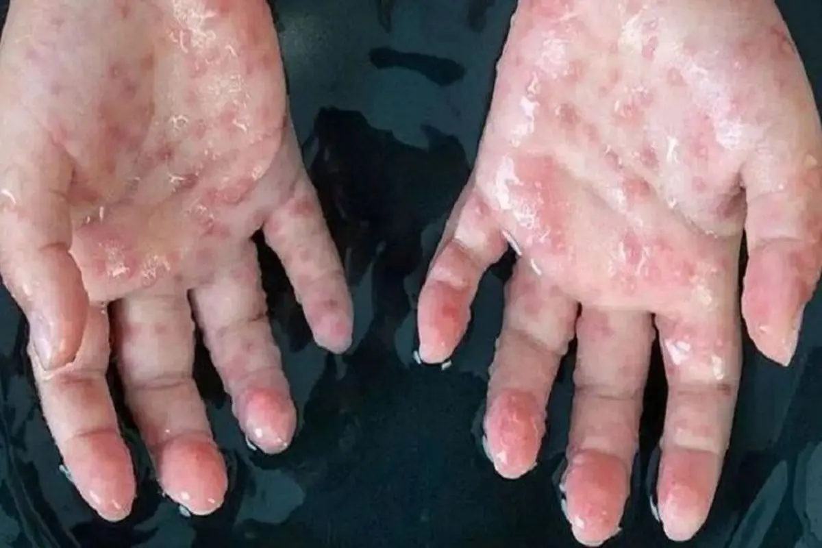 جزئیات جدید از زن ایرانی مبتلا به آبله میمونی در اهواز