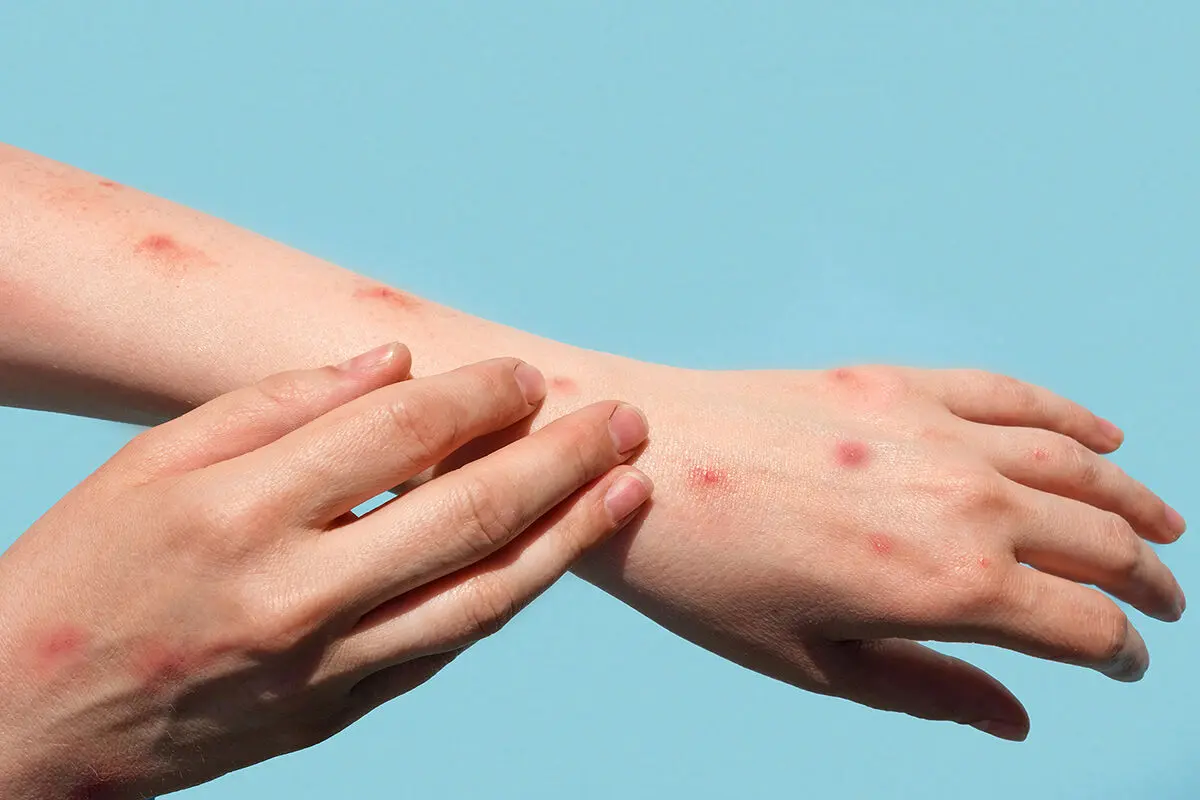 ابتلای بیش از ۵۰ هزار نفر در جهان به آبله میمون