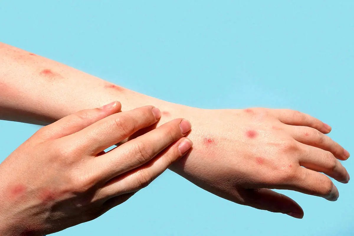 ابتلای بیش از ۵۰ هزار نفر در جهان به آبله میمون
