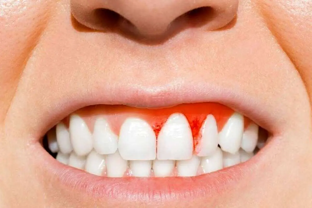 چهار بیماری مرتبط با بیماری لثه