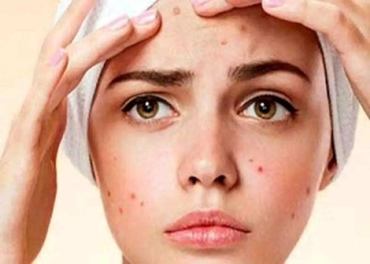 ساده‌ترین روش از بین بردن جای جوش روی صورت