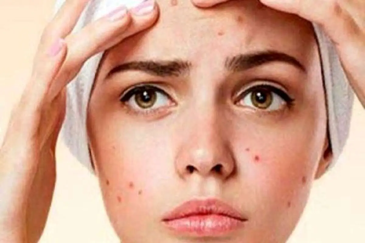 ساده‌ترین روش از بین بردن جای جوش روی صورت