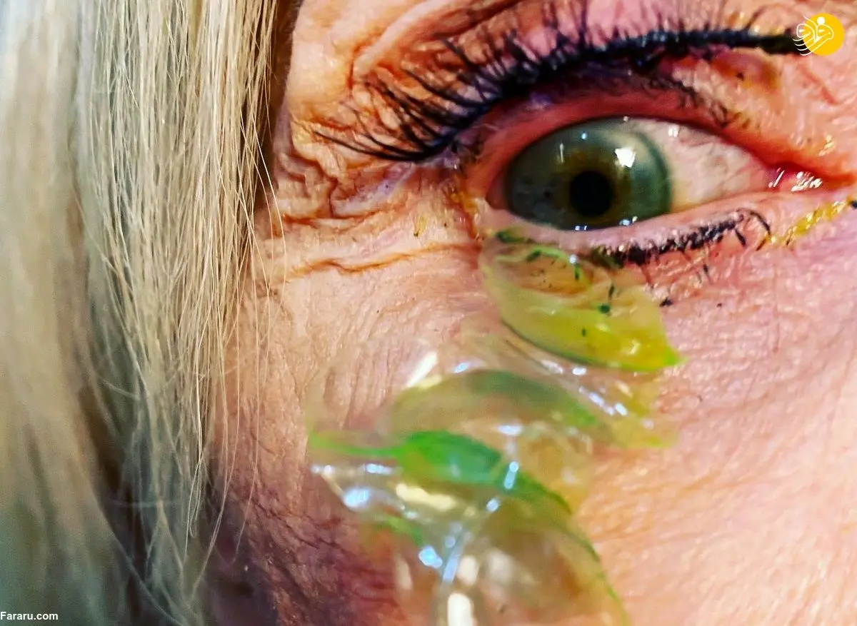 (ویدئو) خارج کردن ۲۳ لنز از چشم یک زن!