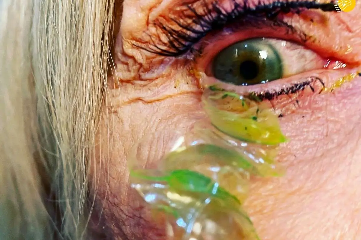 (ویدئو) خارج کردن ۲۳ لنز از چشم یک زن!