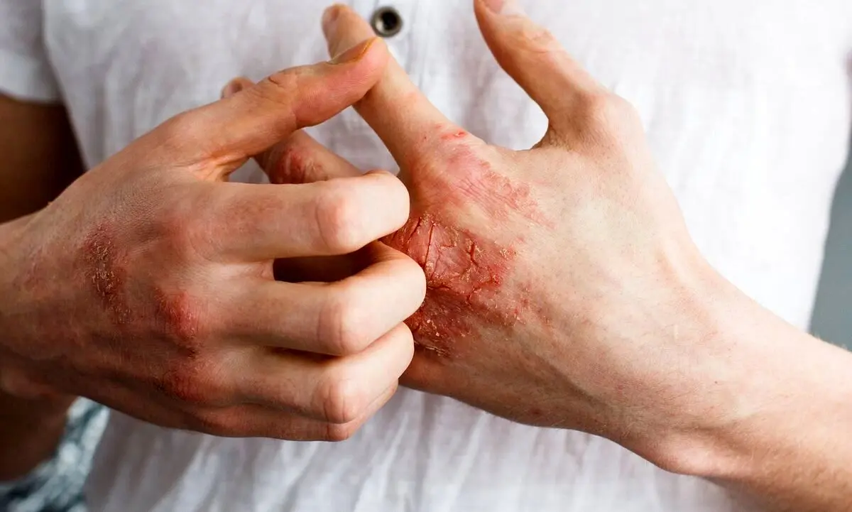 ۷ ماده غذایی برای مقابله با خشکی پوست در فصول سرد