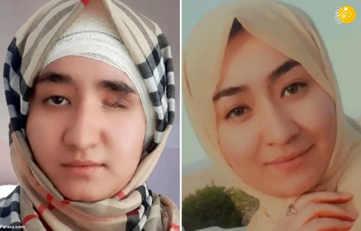 (ویدئو) شاهکار دختر هزاره بازمانده از انفجار انتحاری