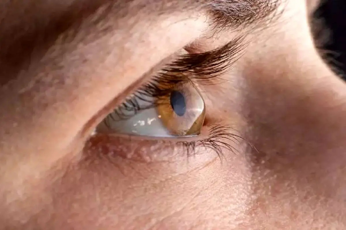(ویدئو) بیماری بیرونزدگی چشم چگونه به وجود میآید؟