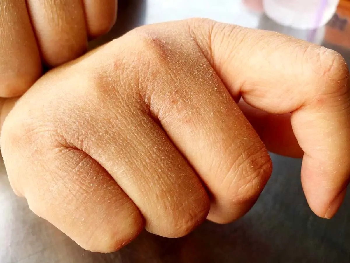 چند توصیه برای کاهش خشکی پوست