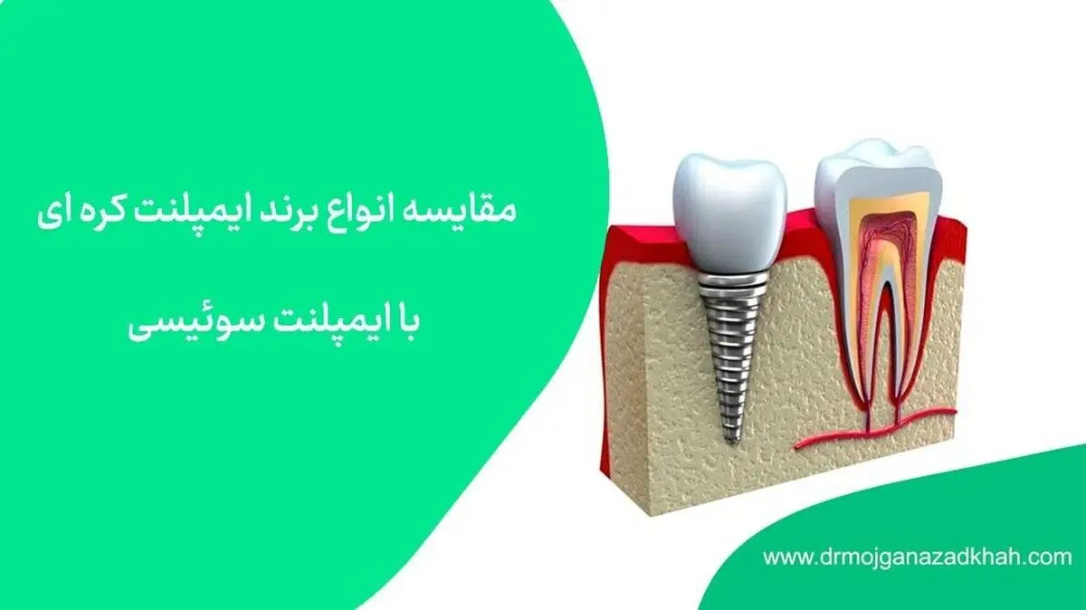 مقایسه انواع برند ایمپلنت کره­ای با ایمپلنت سوئیسی