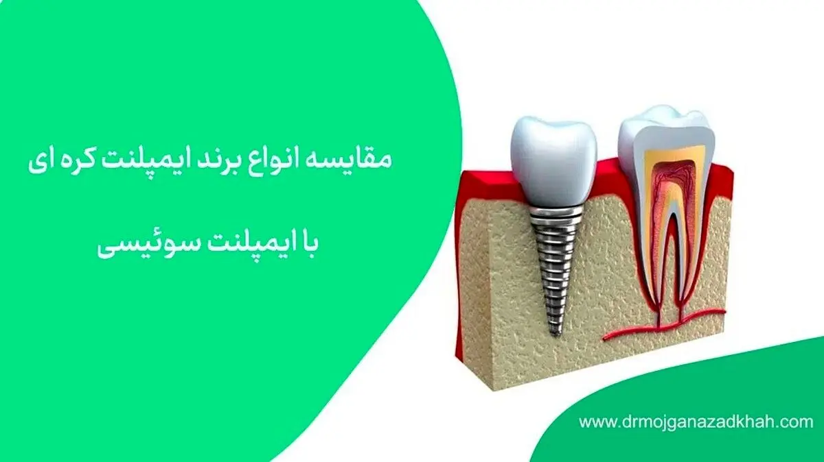 مقایسه انواع برند ایمپلنت کره­ای با ایمپلنت سوئیسی