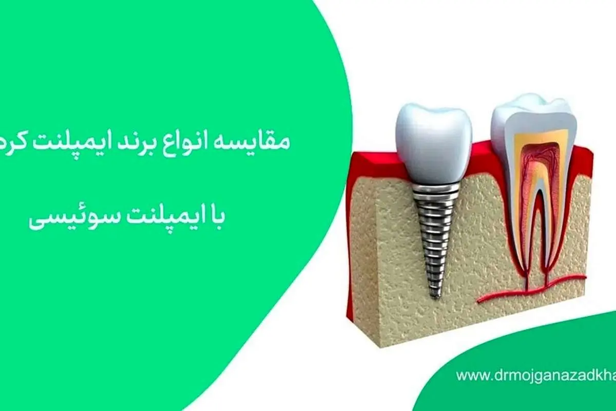 مقایسه انواع برند ایمپلنت کرهای با ایمپلنت سوئیسی